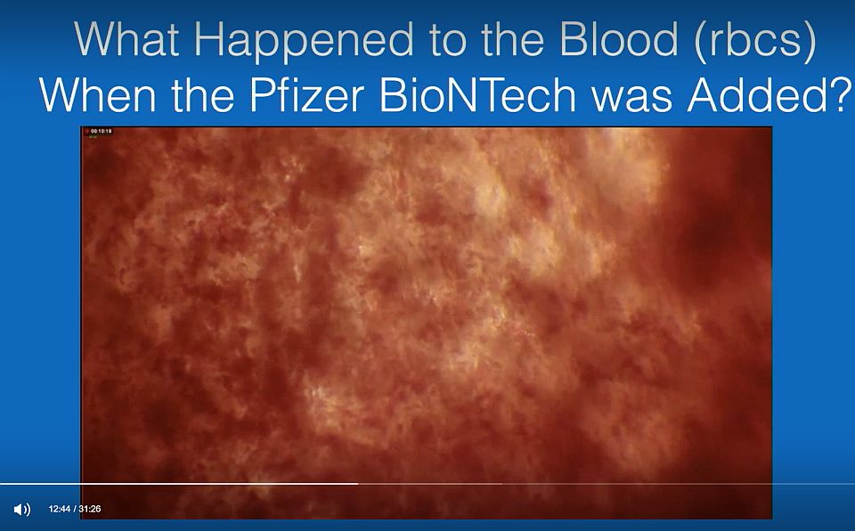 Vér képe Pfizer-BioNTech-oltást hozzáadása után