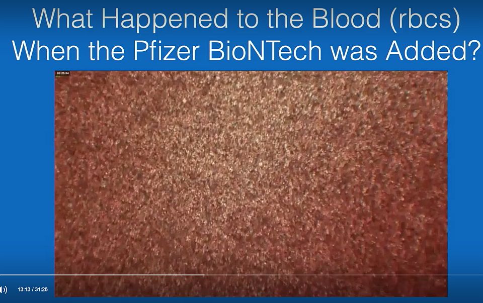 Elhalványodott színű vér képe a Pfizer-BioNTech-oltást hozzáadása után