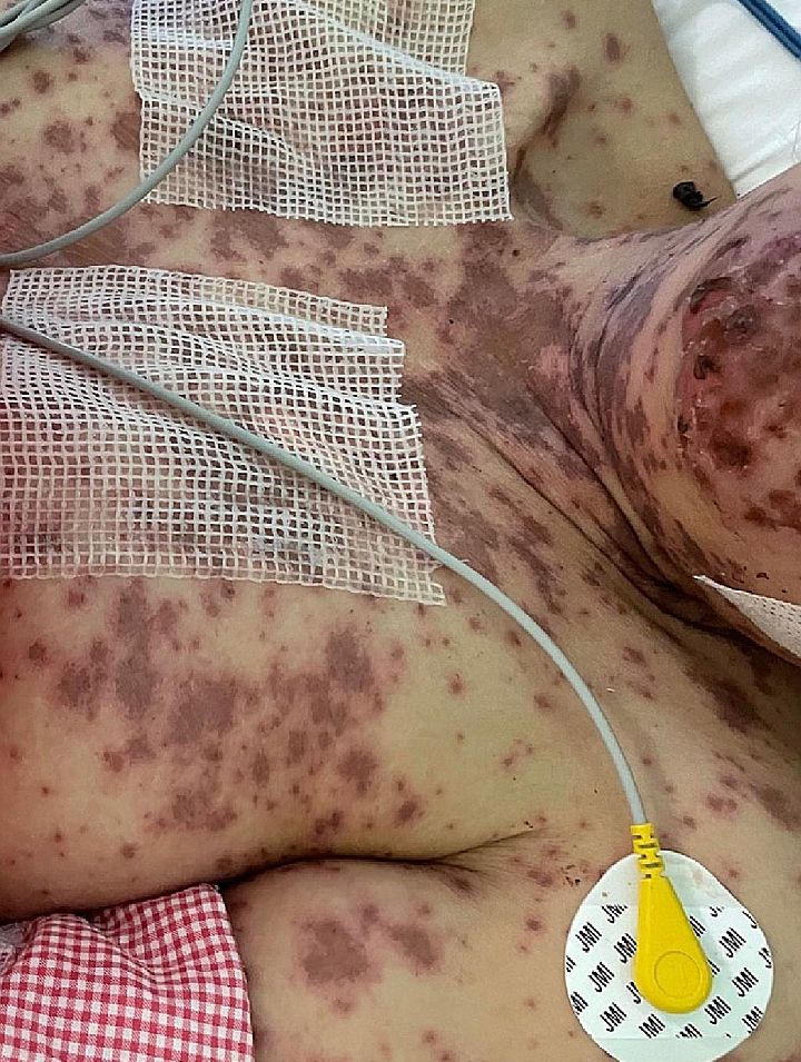 Stevens-Johnson-szindróma/toxikus epidermális nekrolízis egy nőnél a COVID-oltás után