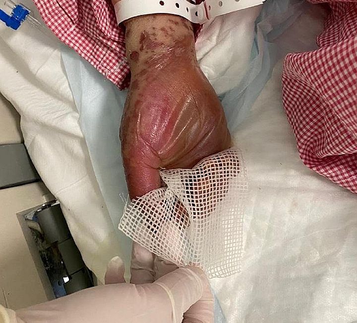 Stevens-Johnson-szindróma/toxikus epidermális nekrolízis egy nőnél a COVID-oltás után