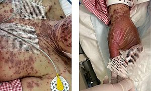 Stevens-Johnson-szindróma/toxikus epidermális nekrolízis egy nőnél a COVID-oltás után