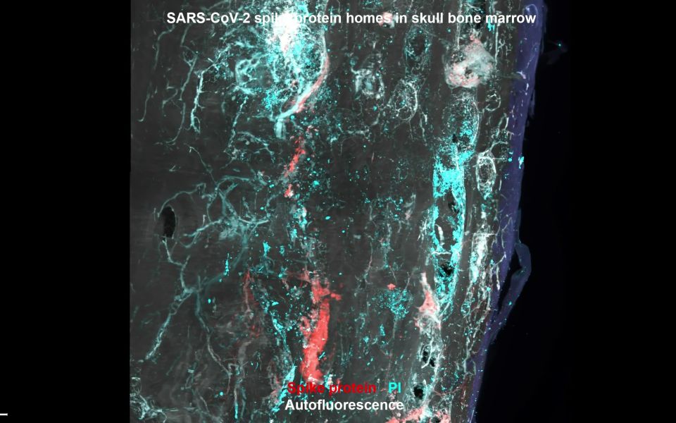 ​Tüskefehérjék ​a koponyacsontvelőben egy SARS-CoV-2-vel fertőzött elhunyt személynél