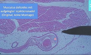 Deltaizom injekciós tűvel